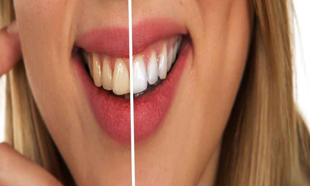 A smiling woman confidently showcasing her whiter teeth, representing the effectiveness of at-home teeth whitening.